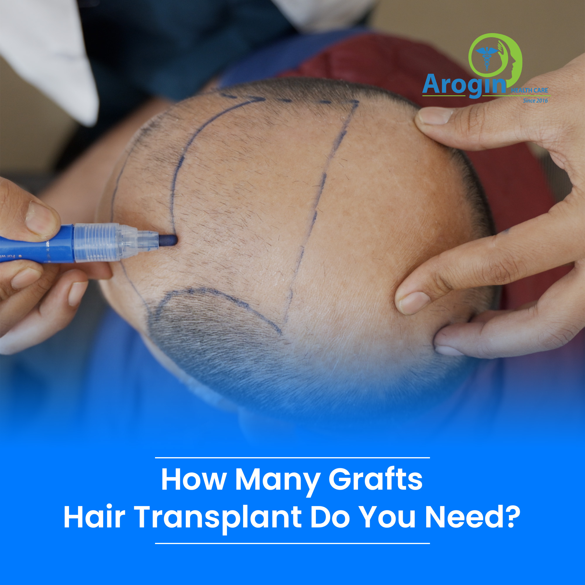 How Many Grafts Hair Transplant Do You Need?